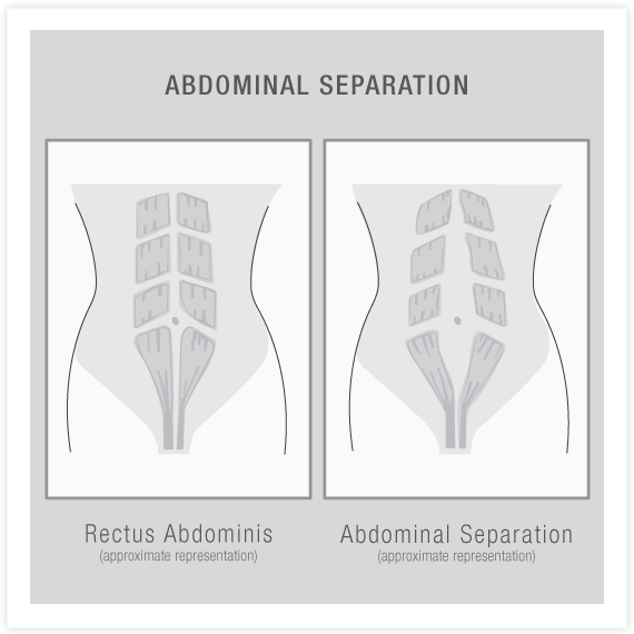 Modifications for Abdominal Separation